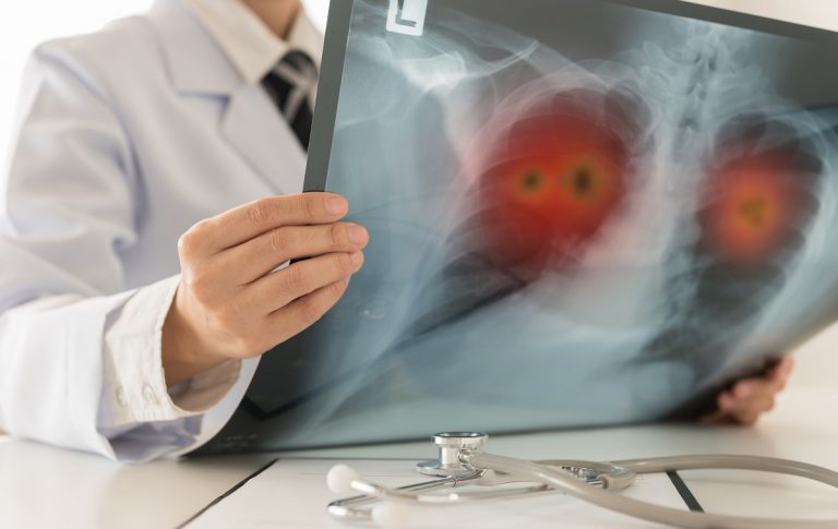 doctor examining a chest xray