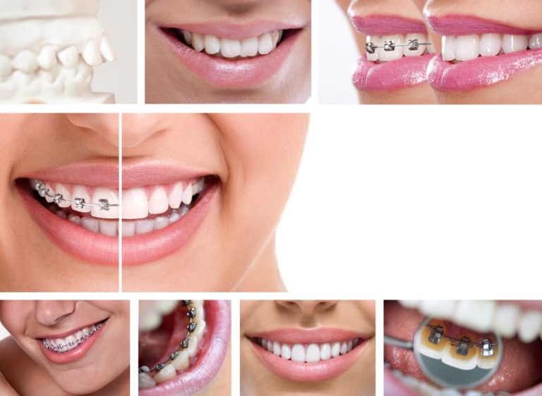 close up of dental braces